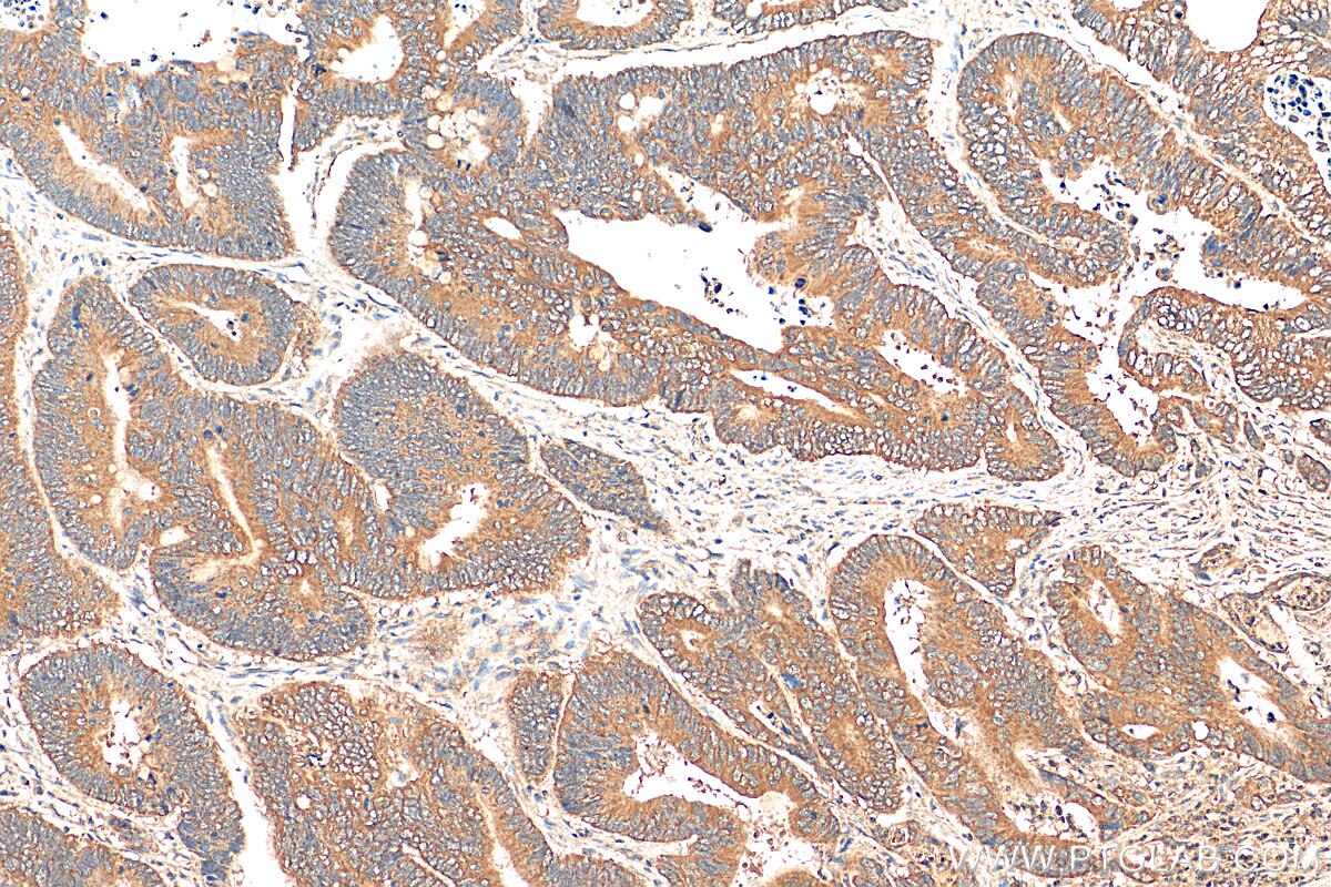 IHC staining of human colon cancer using 29935-1-AP