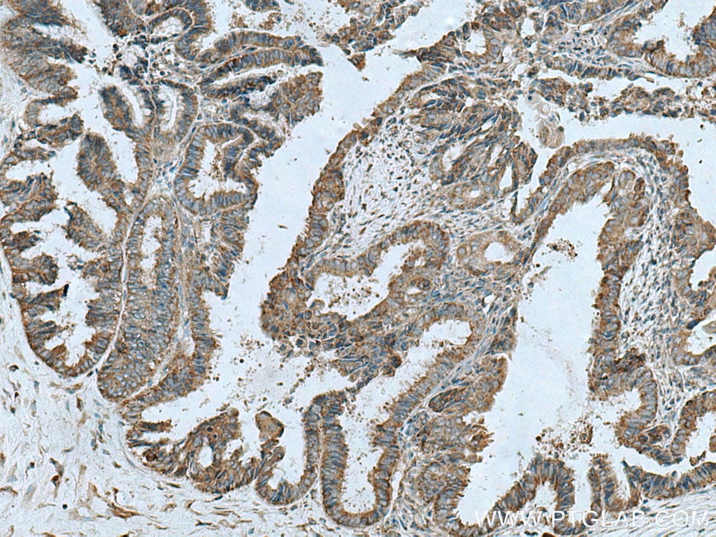 IHC staining of human ovary tumor using 19690-1-AP