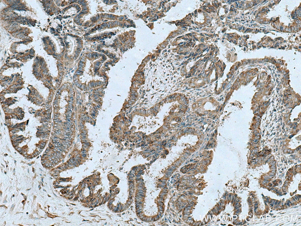 Immunohistochemistry (IHC) staining of human ovary tumor tissue using EIF2C1-Specific Polyclonal antibody (19690-1-AP)