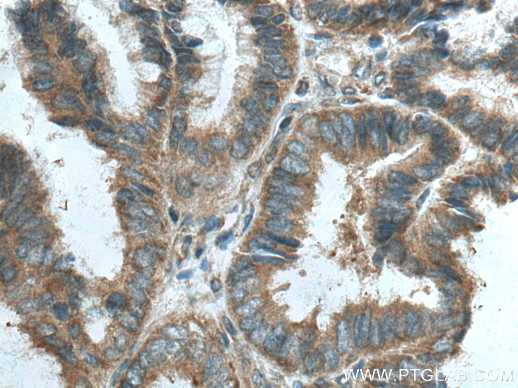 Immunohistochemistry (IHC) staining of human ovary tumor tissue using EIF2C1-Specific Polyclonal antibody (19690-1-AP)