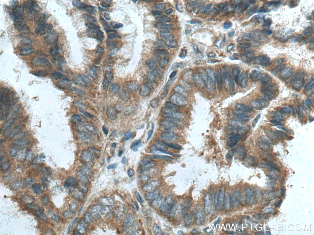 IHC staining of human ovary tumor using 19690-1-AP