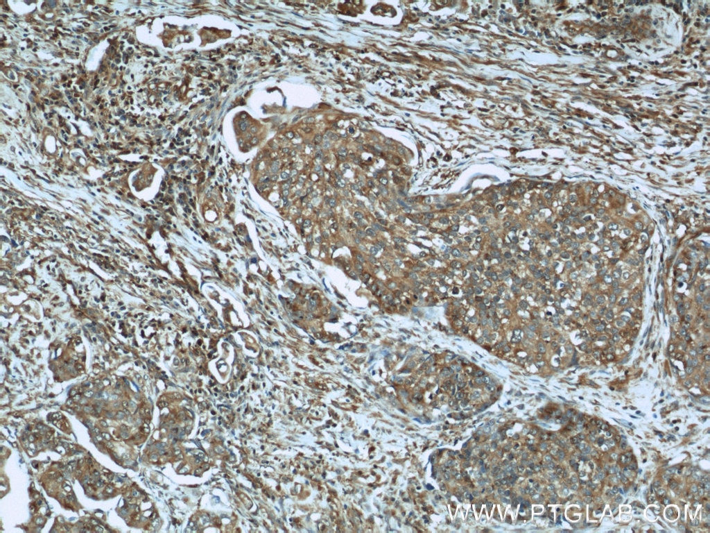 Immunohistochemistry (IHC) staining of human cervical cancer tissue using EIF2C1-Specific Polyclonal antibody (19690-1-AP)
