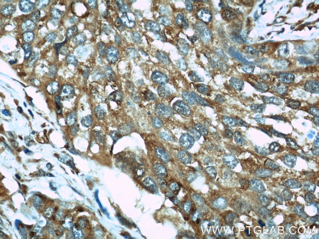 Immunohistochemistry (IHC) staining of human cervical cancer tissue using EIF2C1-Specific Polyclonal antibody (19690-1-AP)