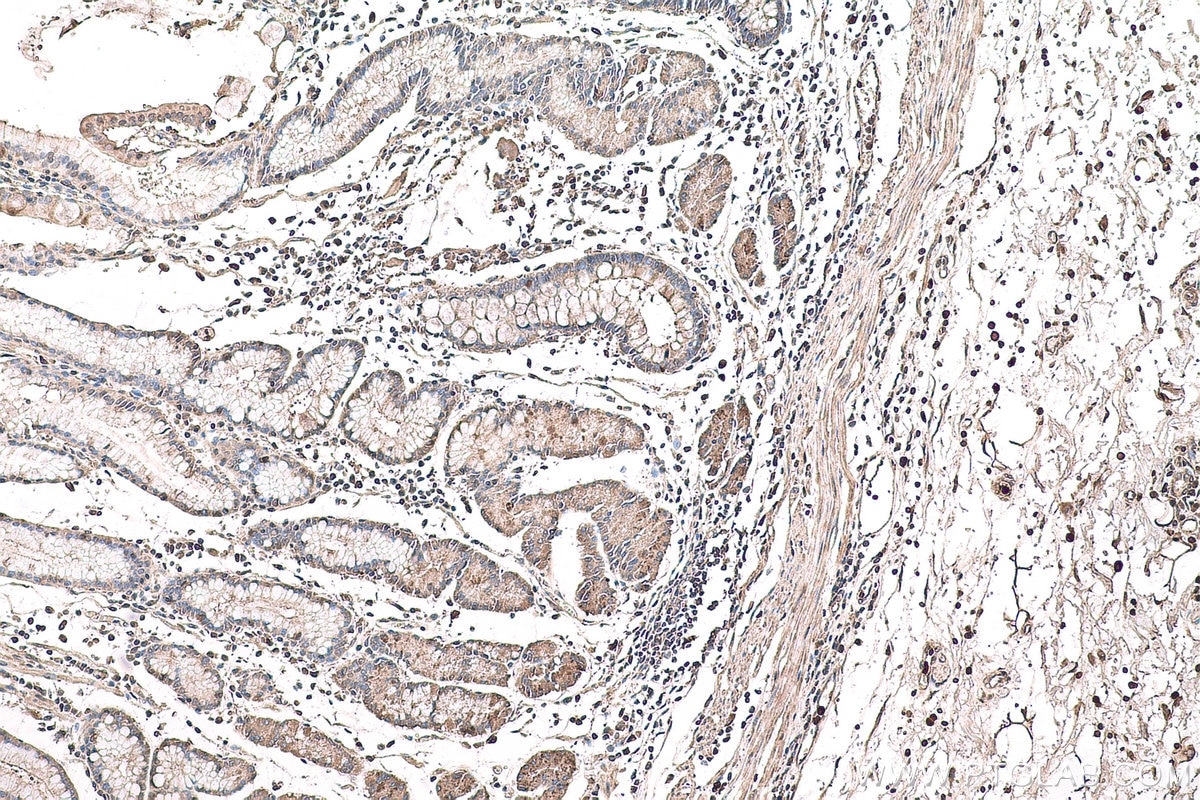 Immunohistochemistry (IHC) staining of human stomach cancer tissue using EIF2C3-Specific Polyclonal antibody (19692-1-AP)