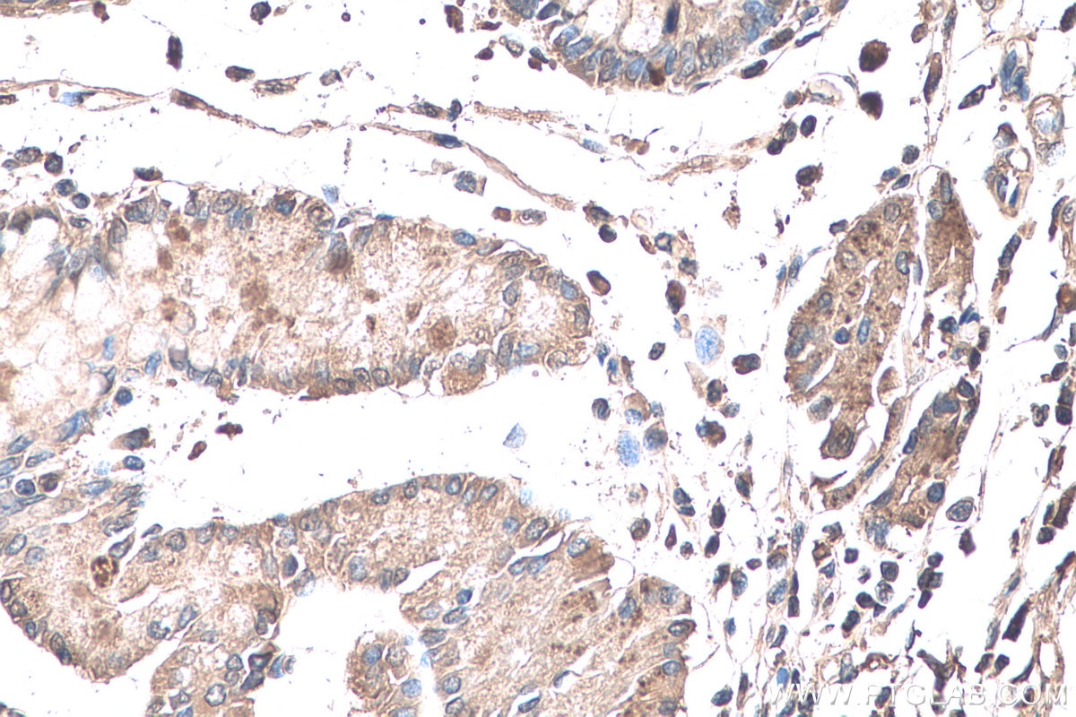 Immunohistochemistry (IHC) staining of human stomach cancer tissue using EIF2C3-Specific Polyclonal antibody (19692-1-AP)