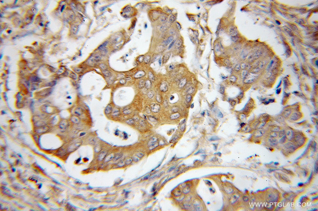 Immunohistochemistry (IHC) staining of human colon cancer tissue using EIF2S1/EIF2A Polyclonal antibody (11170-1-AP)