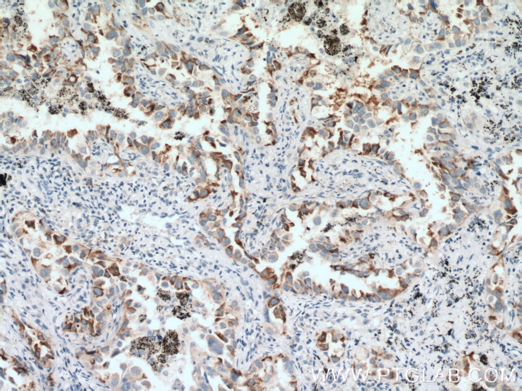 Immunohistochemistry (IHC) staining of human lung cancer tissue using EIF2S3 Polyclonal antibody (11162-1-AP)