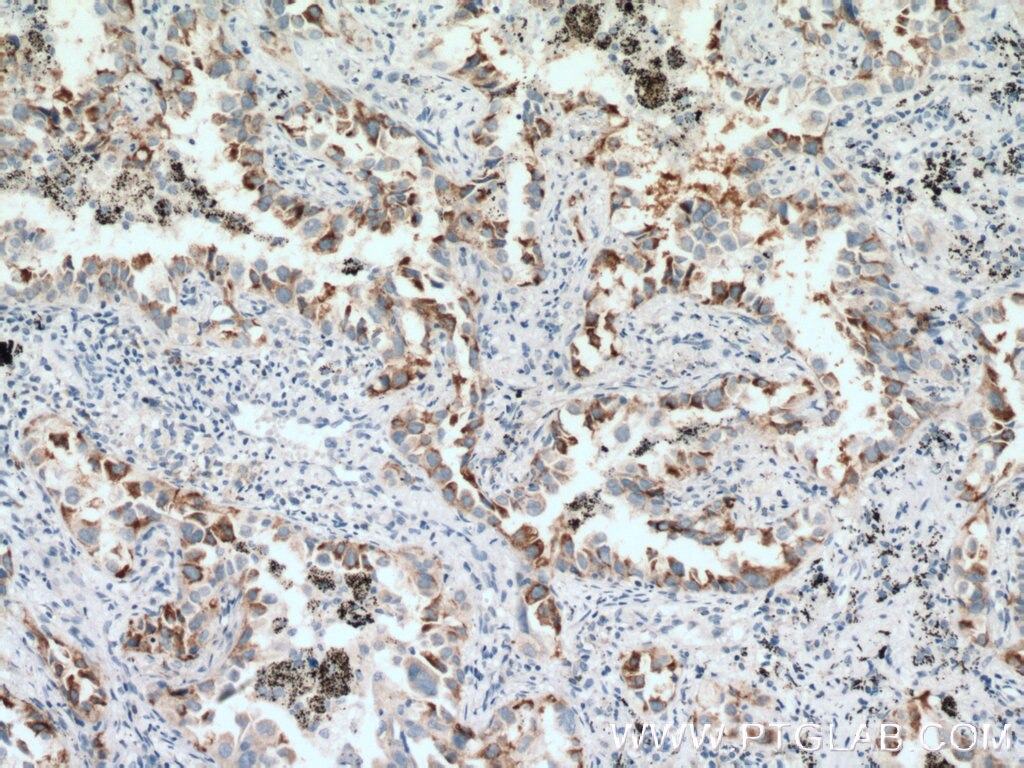 IHC staining of human lung cancer using 11162-1-AP