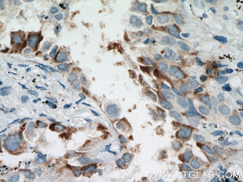 Immunohistochemistry (IHC) staining of human lung cancer tissue using EIF2S3 Polyclonal antibody (11162-1-AP)