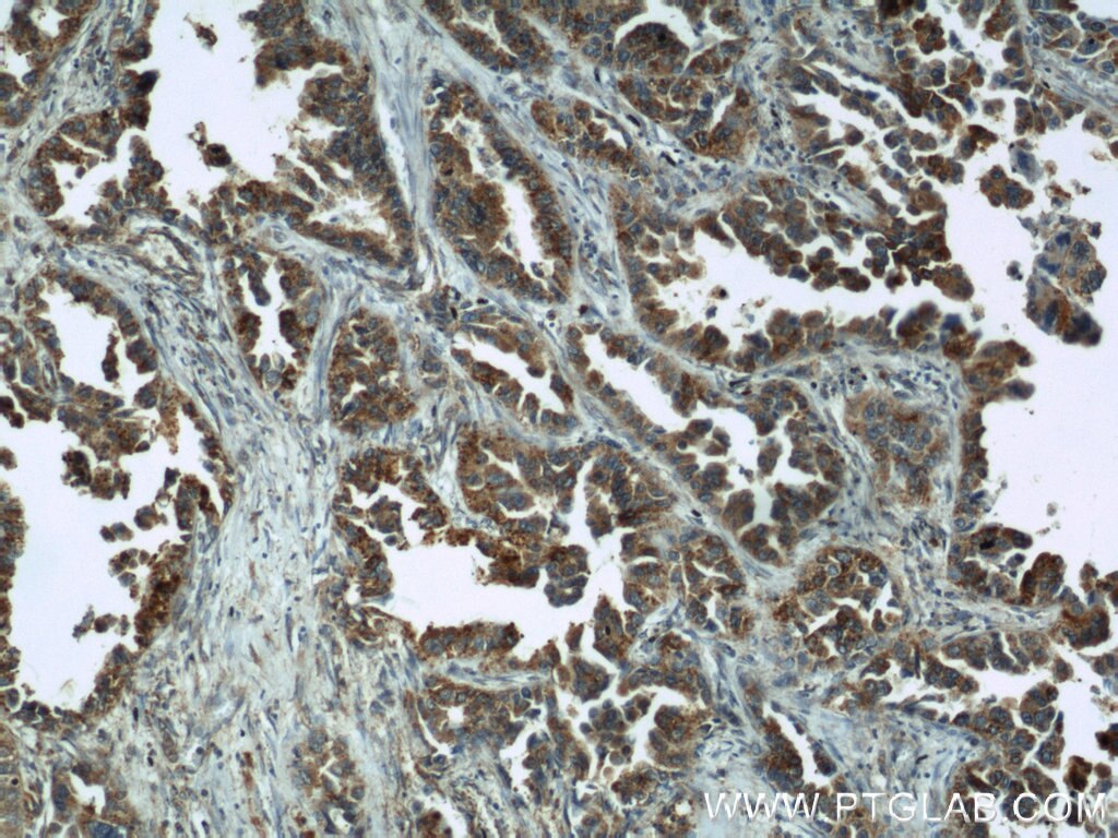 Immunohistochemistry (IHC) staining of human lung cancer tissue using EIF2S3 Polyclonal antibody (11162-1-AP)