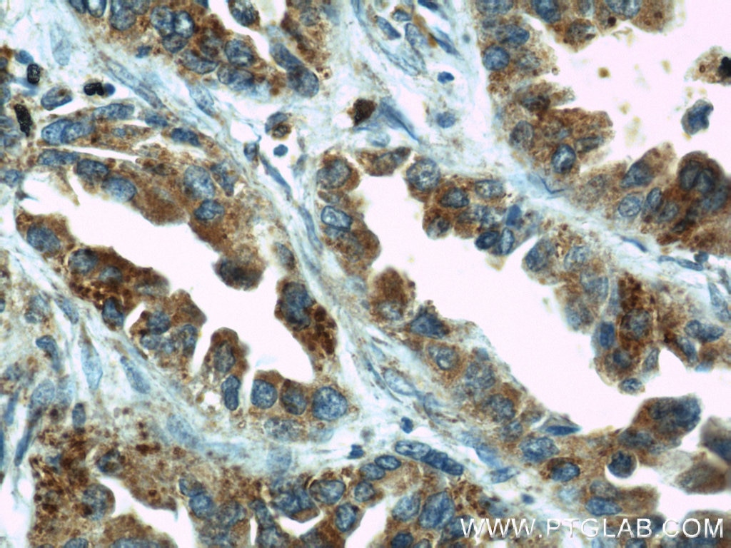 Immunohistochemistry (IHC) staining of human lung cancer tissue using EIF2S3 Polyclonal antibody (11162-1-AP)