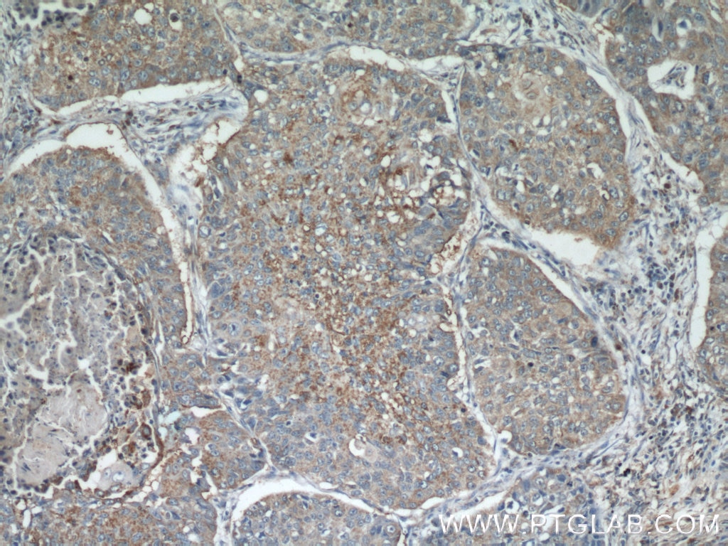 Immunohistochemistry (IHC) staining of human lung cancer tissue using EIF2S3 Polyclonal antibody (11162-1-AP)