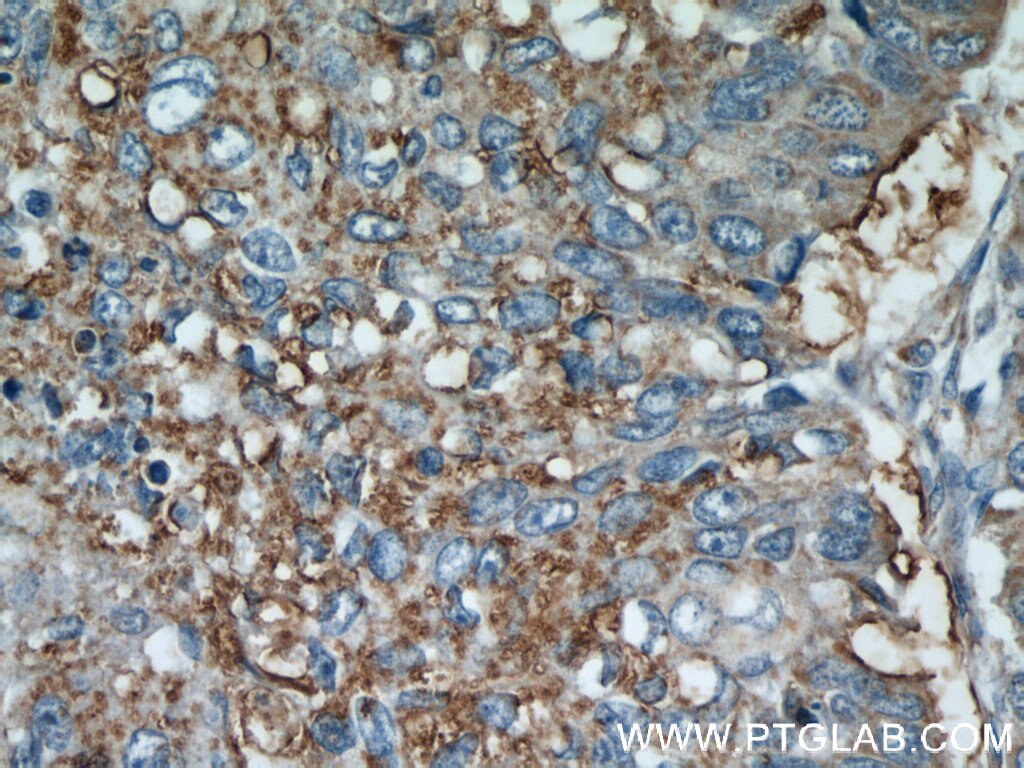 Immunohistochemistry (IHC) staining of human lung cancer tissue using EIF2S3 Polyclonal antibody (11162-1-AP)