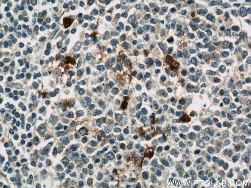 Immunohistochemistry (IHC) staining of human tonsillitis tissue using EIF2S3 Polyclonal antibody (11162-1-AP)