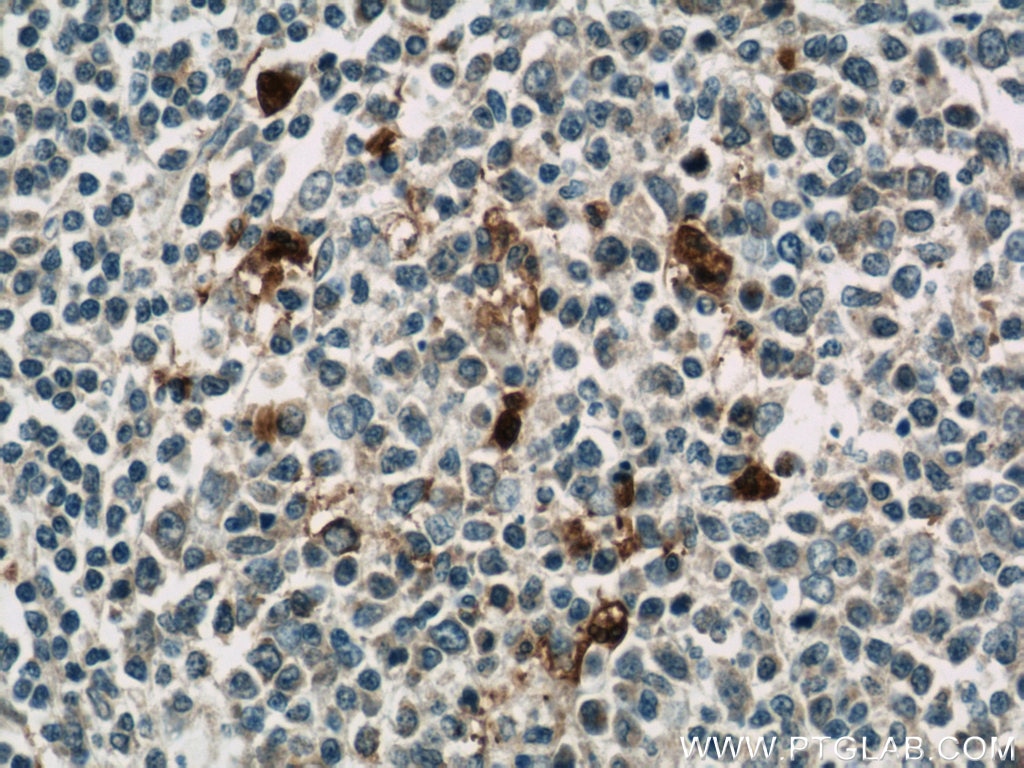 IHC staining of human tonsillitis using 11162-1-AP