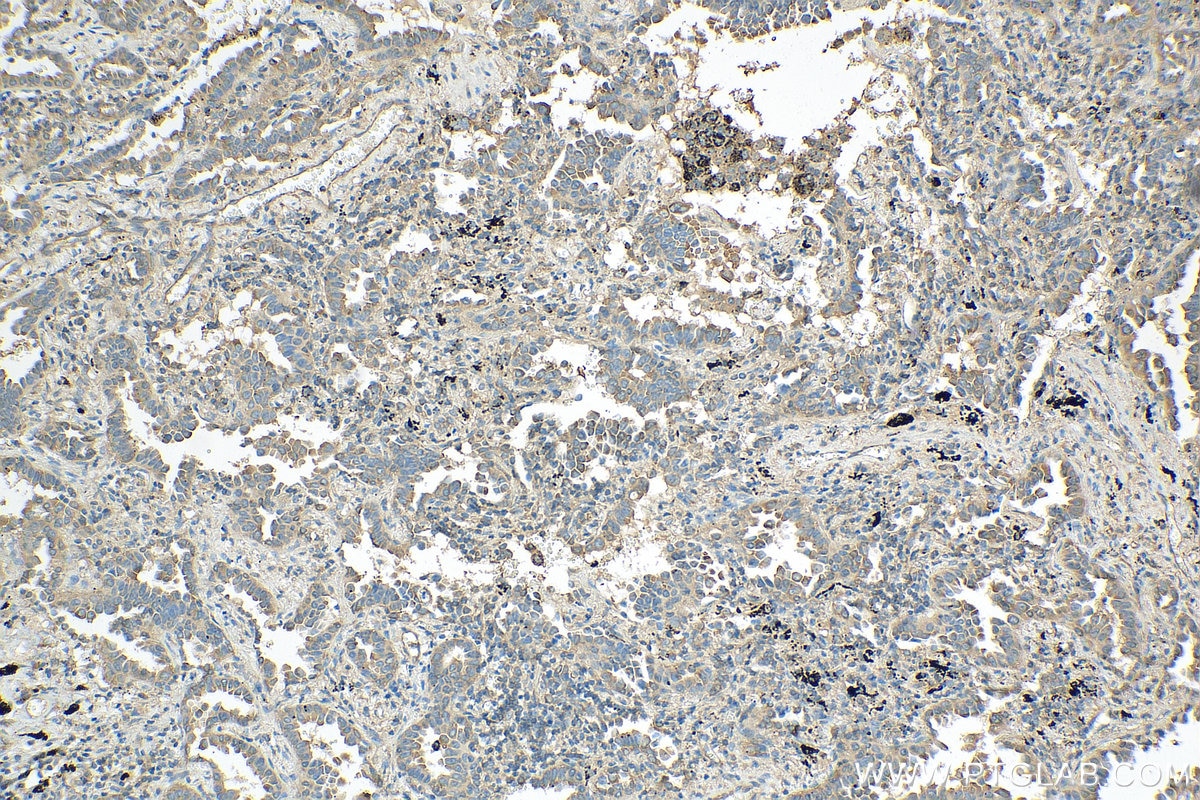 Immunohistochemistry (IHC) staining of human lung cancer tissue using EIF3A Polyclonal antibody (27665-1-AP)