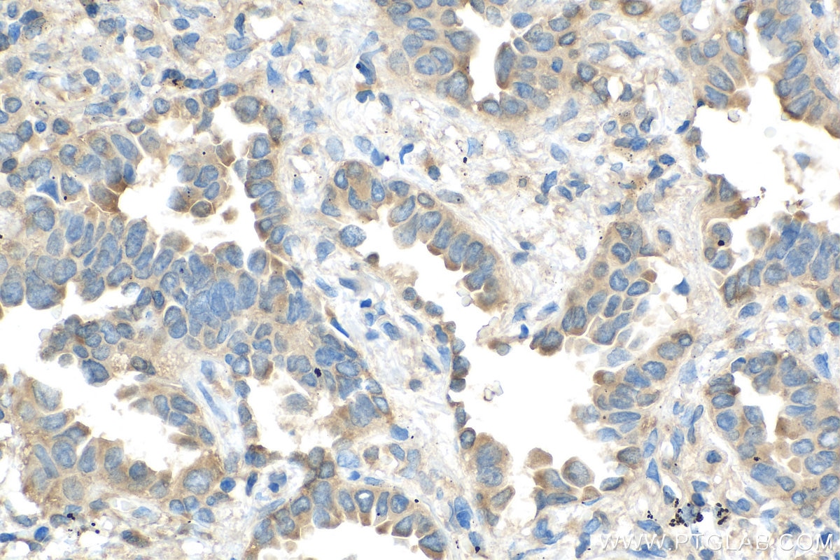 Immunohistochemistry (IHC) staining of human lung cancer tissue using EIF3A Polyclonal antibody (27665-1-AP)