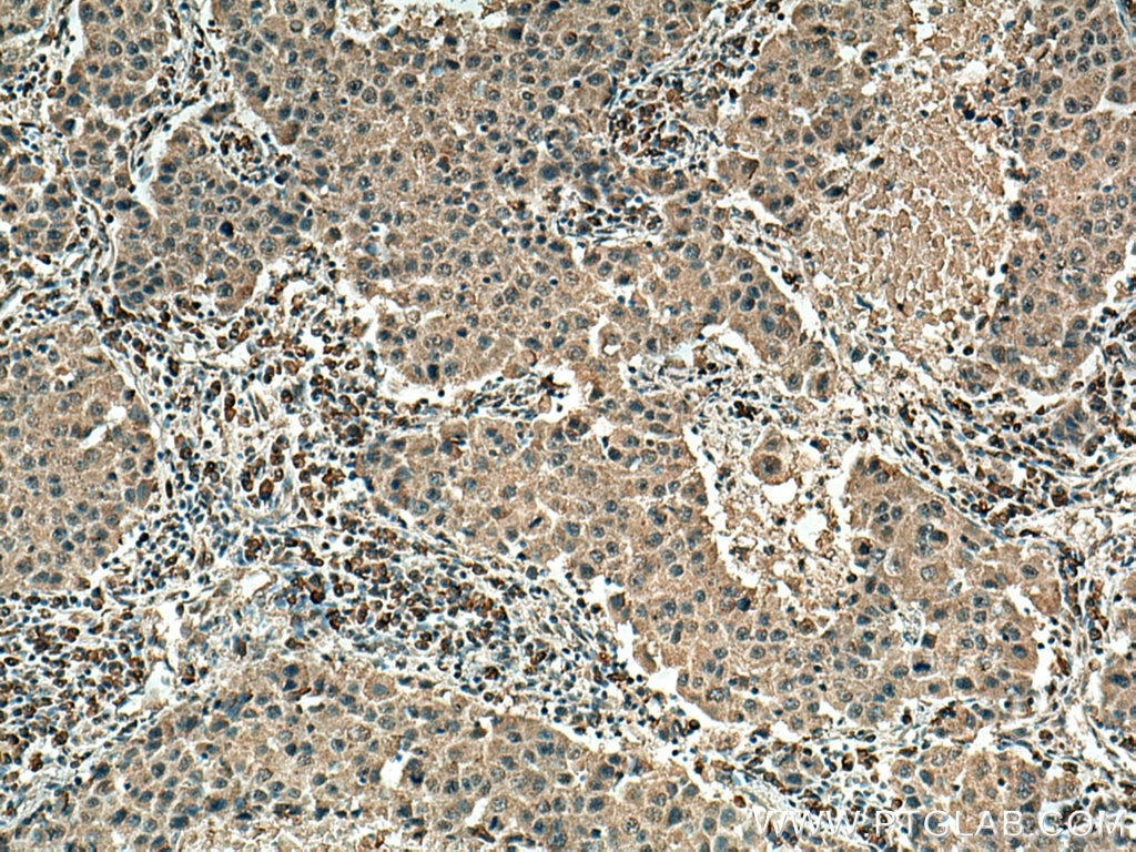 Immunohistochemistry (IHC) staining of human breast cancer tissue using EIF3A Monoclonal antibody (67713-1-Ig)