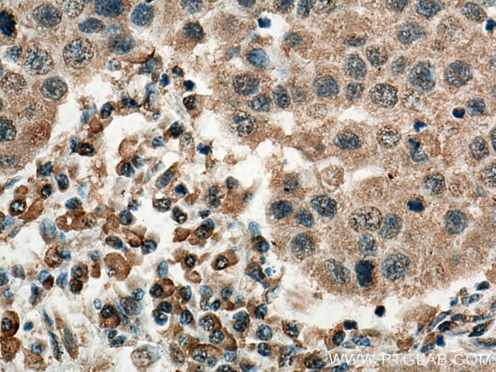 Immunohistochemistry (IHC) staining of human breast cancer tissue using EIF3A Monoclonal antibody (67713-1-Ig)