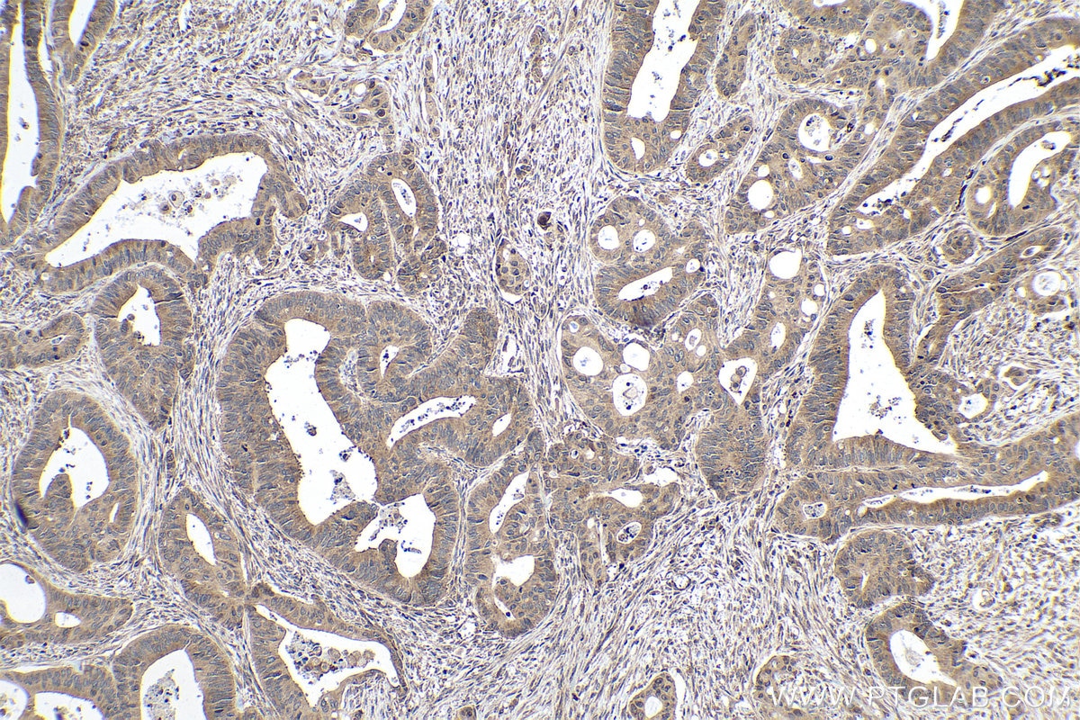 Immunohistochemistry (IHC) staining of human colon cancer tissue using EIF3C Polyclonal antibody (12733-1-AP)