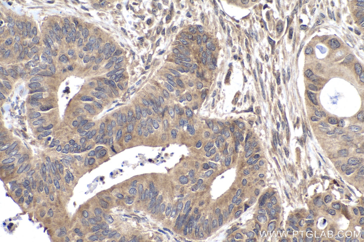 Immunohistochemistry (IHC) staining of human colon cancer tissue using EIF3C Polyclonal antibody (12733-1-AP)