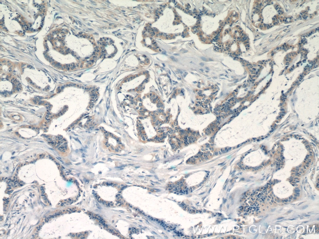 Immunohistochemistry (IHC) staining of human breast cancer tissue using EIF3D Polyclonal antibody (10219-1-AP)