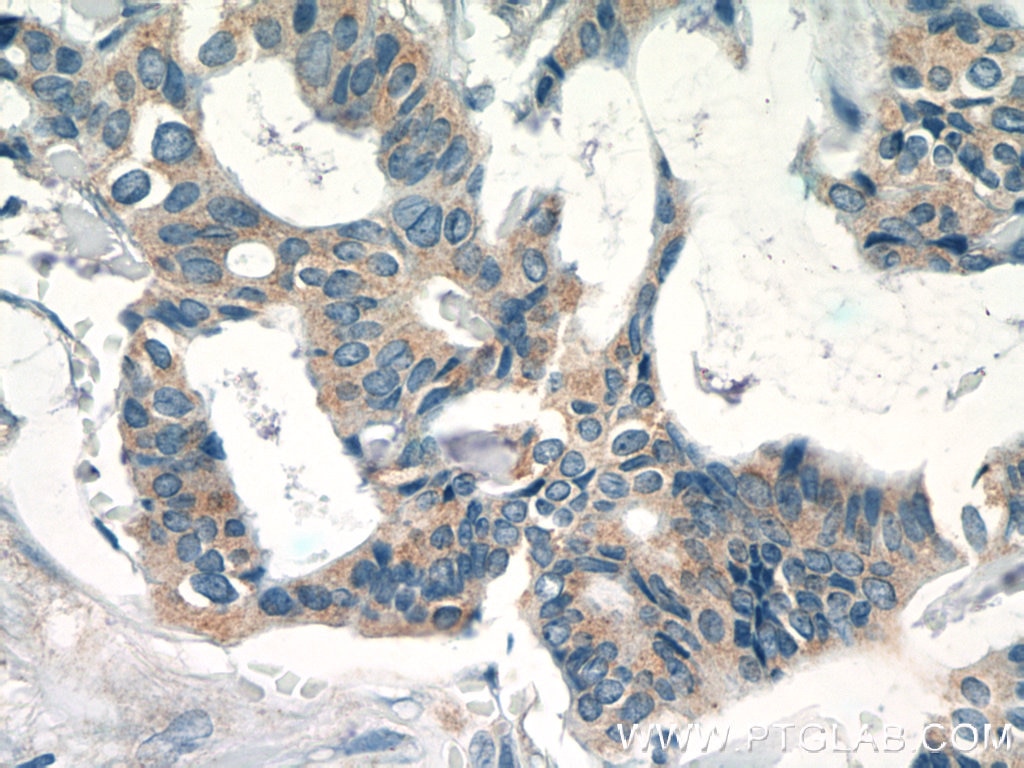 Immunohistochemistry (IHC) staining of human breast cancer tissue using EIF3D Polyclonal antibody (10219-1-AP)