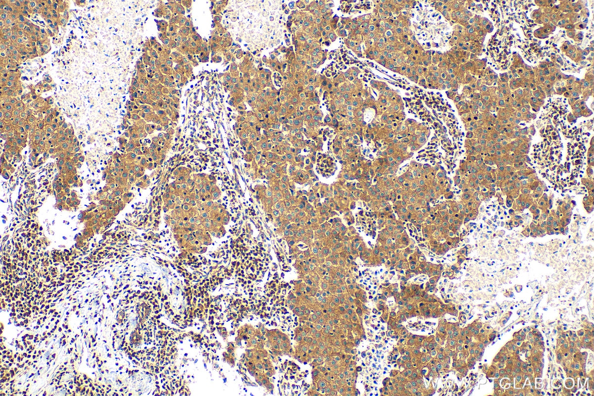 IHC staining of human breast cancer using 82512-1-RR