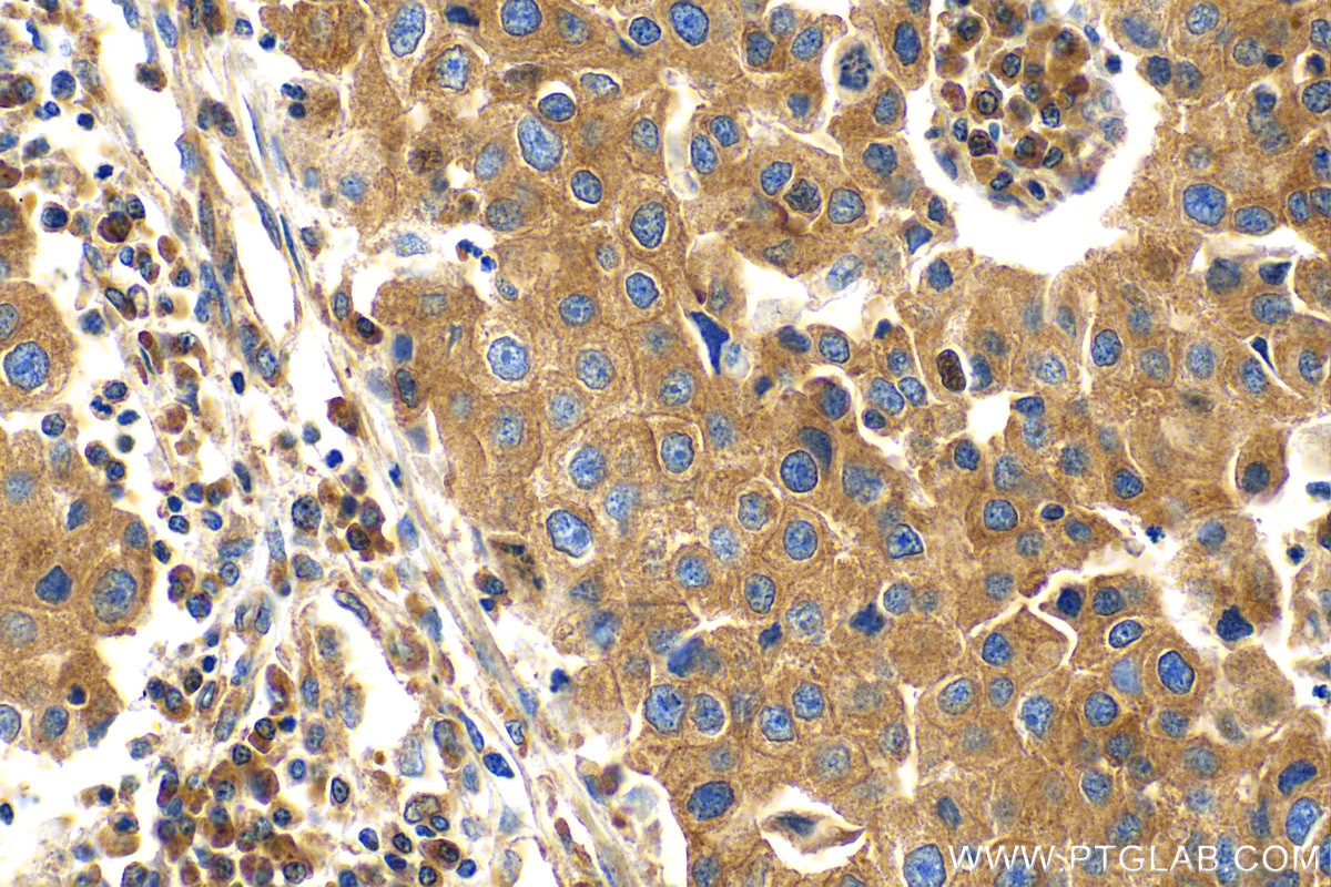 Immunohistochemistry (IHC) staining of human breast cancer tissue using EIF3D Recombinant antibody (82512-1-RR)