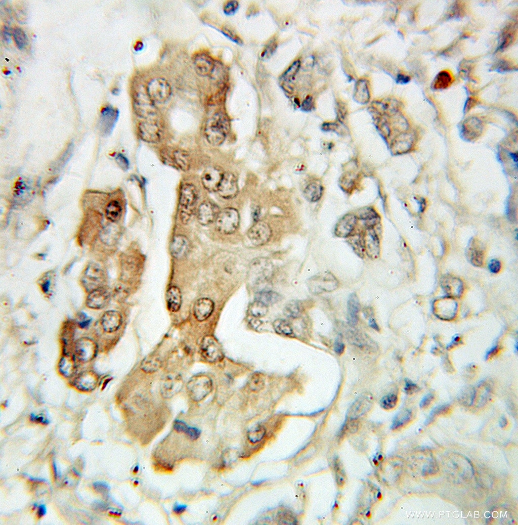 Immunohistochemistry (IHC) staining of human pancreas cancer tissue using EIF3E Polyclonal antibody (10899-1-AP)