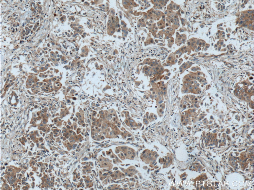 Immunohistochemistry (IHC) staining of human breast cancer tissue using EIF3E Polyclonal antibody (11352-1-AP)