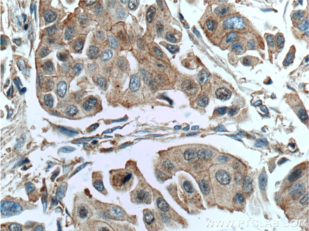 Immunohistochemistry (IHC) staining of human breast cancer tissue using EIF3E Polyclonal antibody (11352-1-AP)