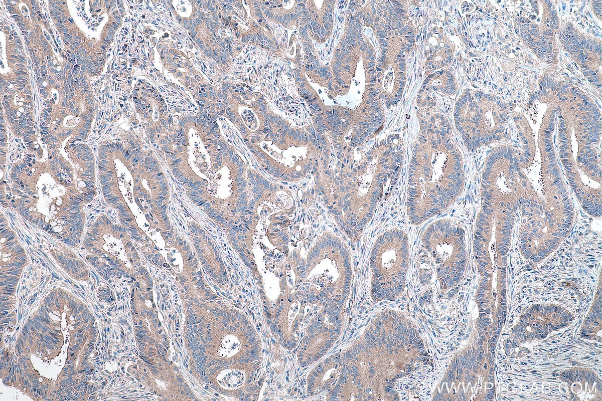 Immunohistochemistry (IHC) staining of human colon cancer tissue using EIF3G Polyclonal antibody (11165-1-AP)