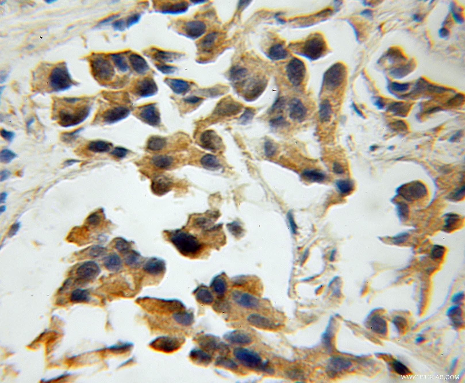 Immunohistochemistry (IHC) staining of human prostate cancer tissue using EIF3G Polyclonal antibody (11165-1-AP)