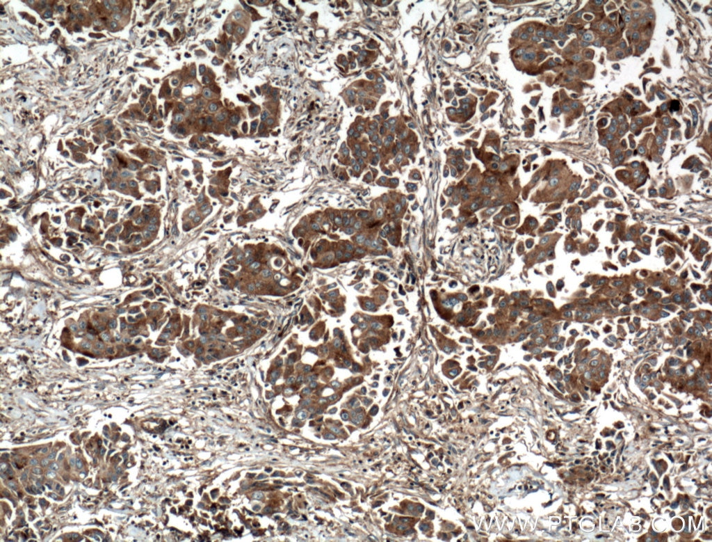 Immunohistochemistry (IHC) staining of human breast cancer tissue using EIF3I Polyclonal antibody (11287-1-AP)