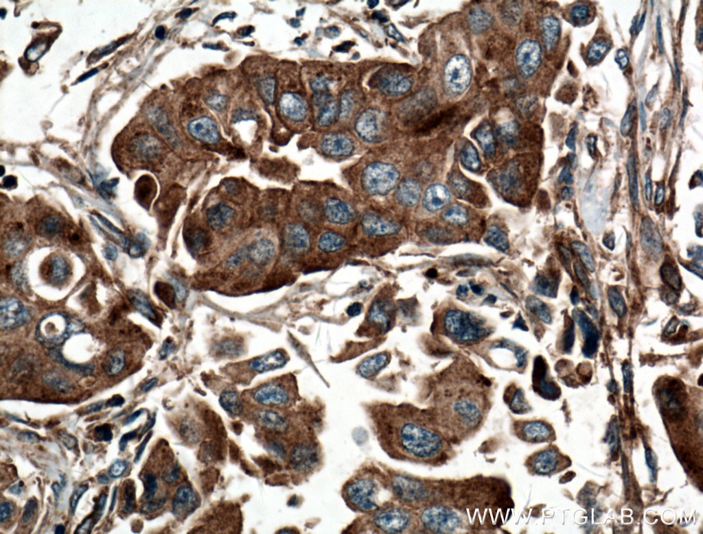 Immunohistochemistry (IHC) staining of human breast cancer tissue using EIF3I Polyclonal antibody (11287-1-AP)