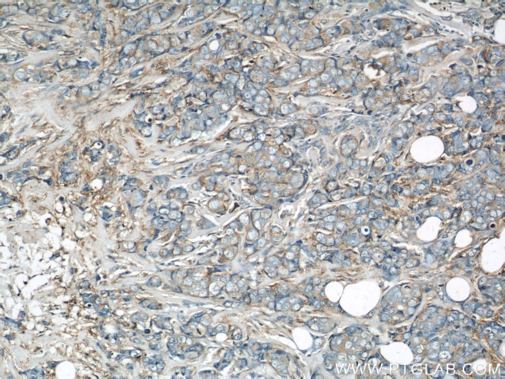 Immunohistochemistry (IHC) staining of human breast cancer tissue using EIF3I Polyclonal antibody (11287-1-AP)