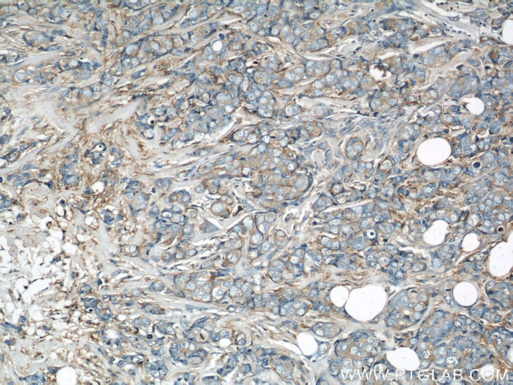 IHC staining of human breast cancer using 11287-1-AP