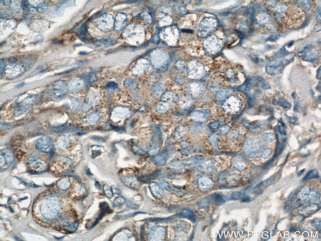 Immunohistochemistry (IHC) staining of human breast cancer tissue using EIF3I Polyclonal antibody (11287-1-AP)