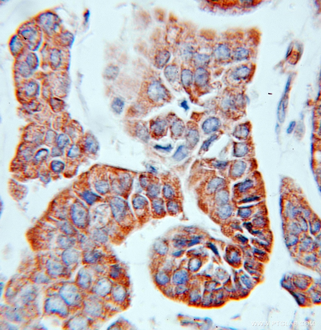 Immunohistochemistry (IHC) staining of human breast cancer tissue using EIF3J Polyclonal antibody (10439-1-AP)