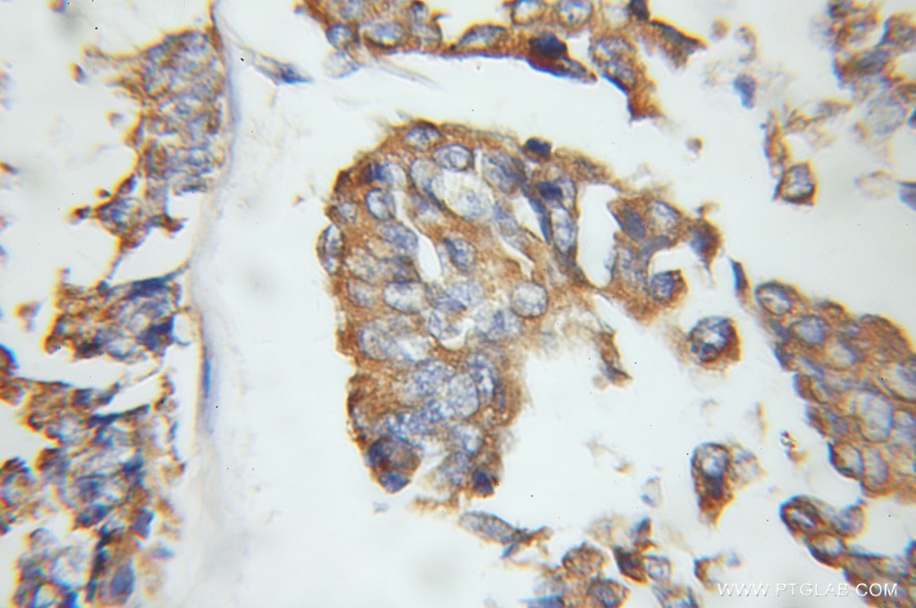 Immunohistochemistry (IHC) staining of human breast cancer tissue using EIF3J Polyclonal antibody (10439-1-AP)