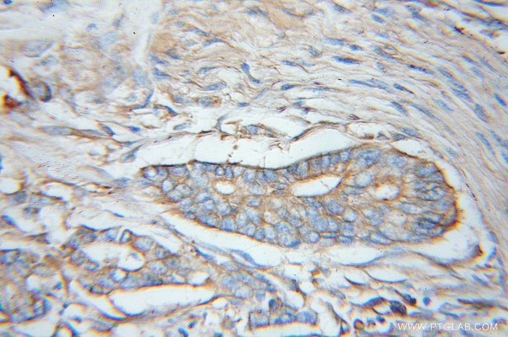 Immunohistochemistry (IHC) staining of human pancreas cancer tissue using EIF3M Polyclonal antibody (11423-1-AP)