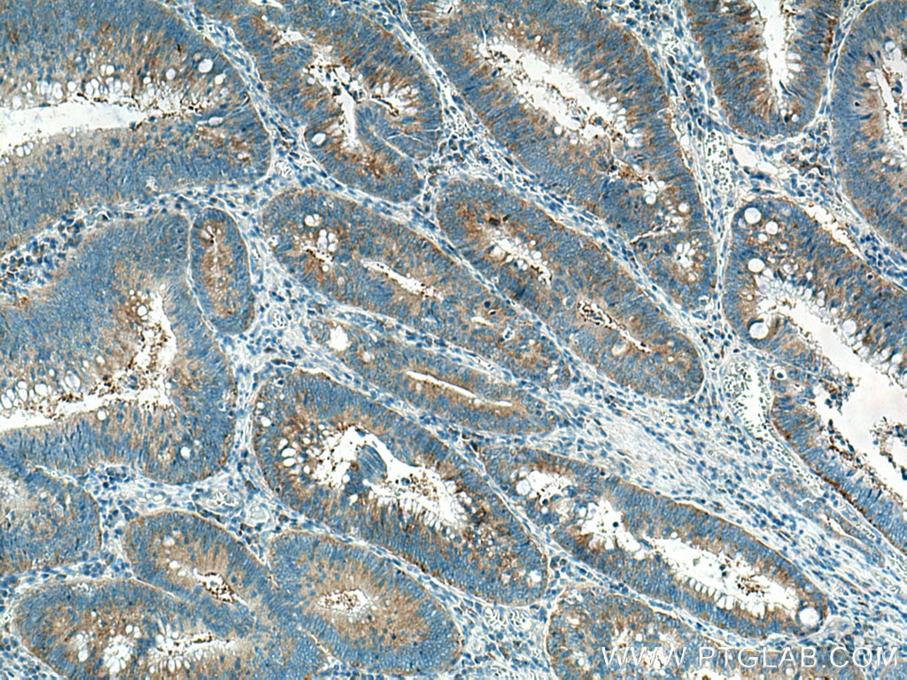 Immunohistochemistry (IHC) staining of human colon cancer tissue using EIF3M Monoclonal antibody (66025-1-Ig)