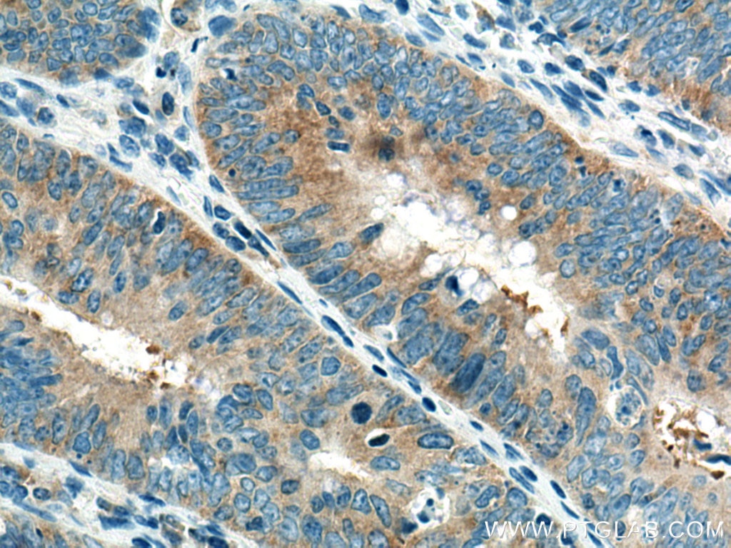 IHC staining of human colon cancer using 66025-1-Ig