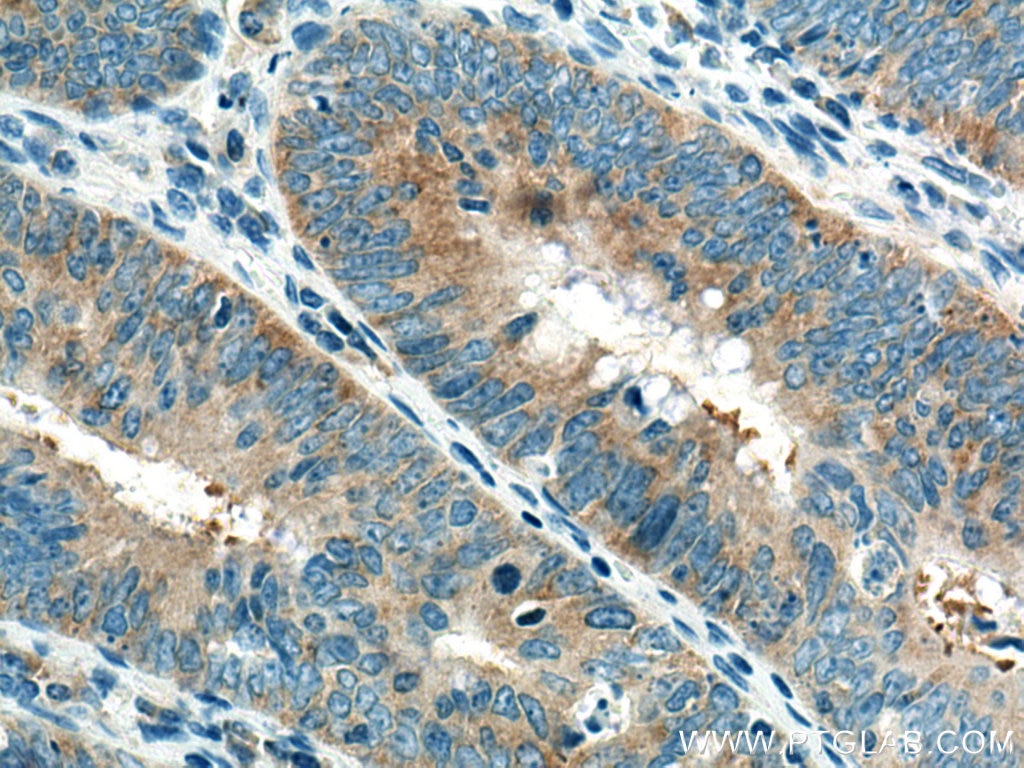 Immunohistochemistry (IHC) staining of human colon cancer tissue using EIF3M Monoclonal antibody (66025-1-Ig)