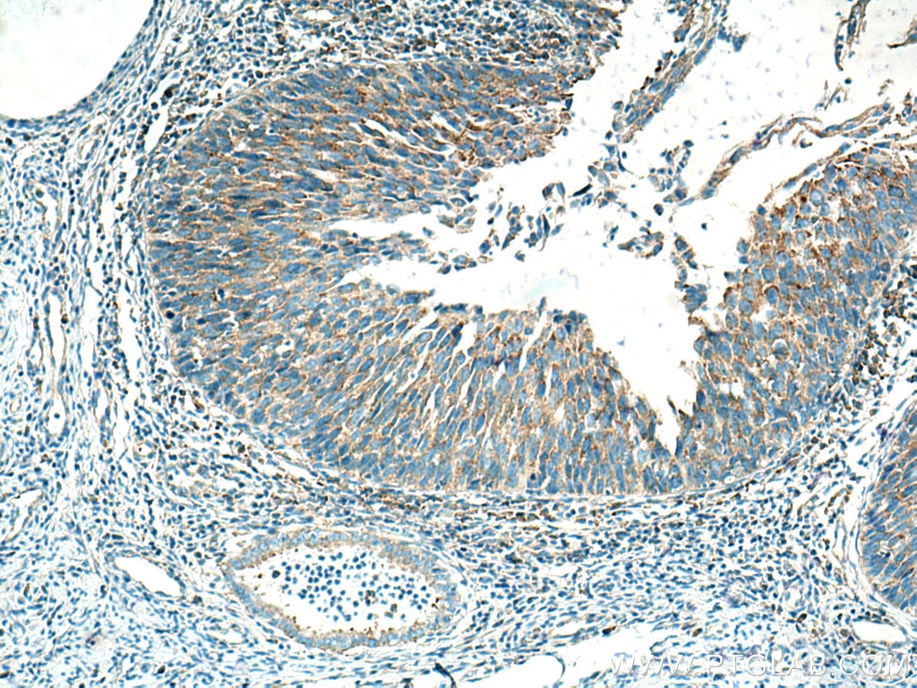 IHC staining of human cervical cancer using 66025-1-Ig