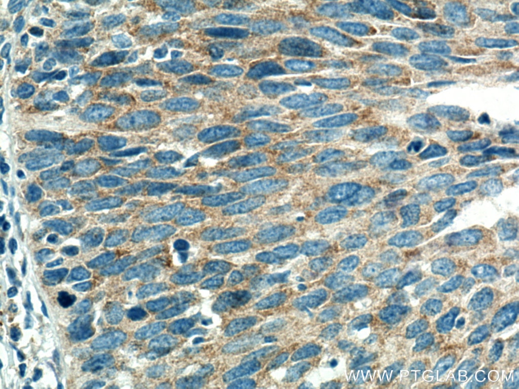 Immunohistochemistry (IHC) staining of human cervical cancer tissue using EIF3M Monoclonal antibody (66025-1-Ig)