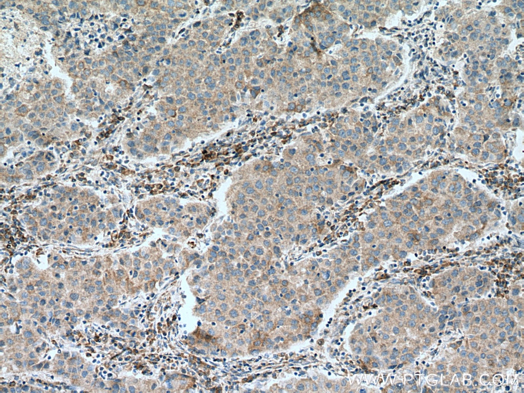 Immunohistochemistry (IHC) staining of human breast cancer tissue using EIF4A2 Polyclonal antibody (11280-1-AP)