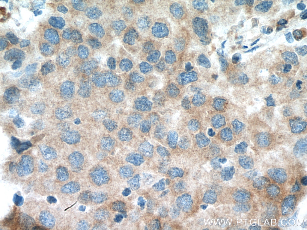 Immunohistochemistry (IHC) staining of human breast cancer tissue using EIF4A2 Polyclonal antibody (11280-1-AP)