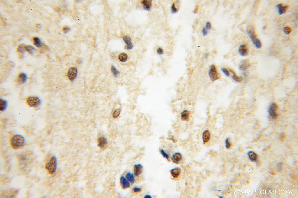 Immunohistochemistry (IHC) staining of human gliomas tissue using EIF4A2 Polyclonal antibody (11280-1-AP)